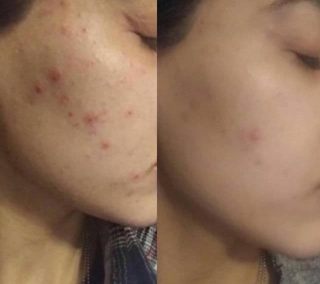 VT COSMETICS Reedle Shot 300 review photo by yuliia444