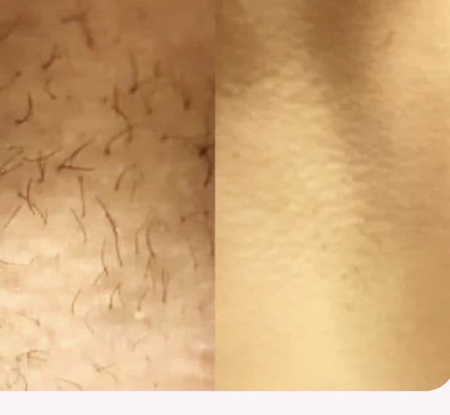 Hey Silky Skin Laser Hair Removal Handset review photo by sukhjeet