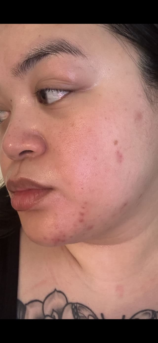 Thayers Rapid Acne Spot Treatment with Niacinamide & 10% Sulfur review photo by BeautyWithAra