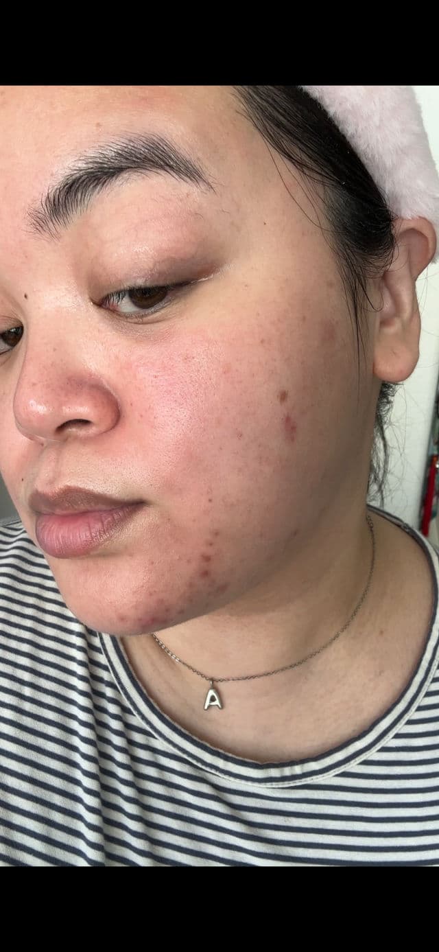 Thayers Rapid Acne Spot Treatment with Niacinamide & 10% Sulfur review photo by BeautyWithAra