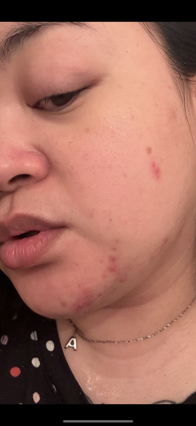 Thayers Rapid Acne Spot Treatment with Niacinamide & 10% Sulfur review photo by BeautyWithAra