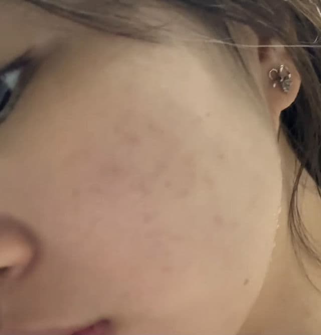 VT COSMETICS Garlic AC Reedle Shot Spot Cream review photo by yeeinaa