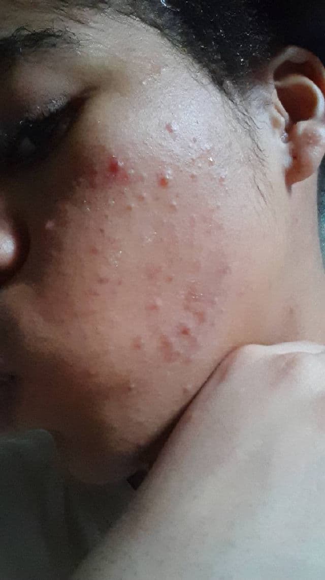 CURENTY Acne Clear Serum review photo by SkinWithNue