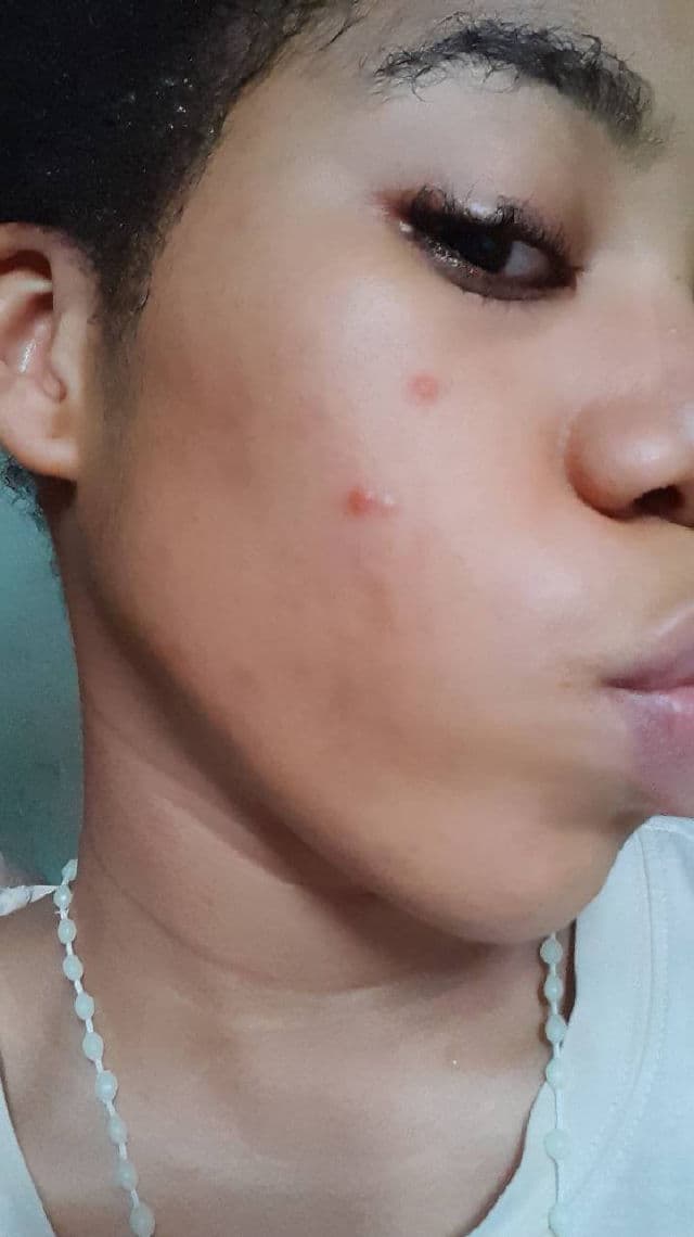 CURENTY Acne Clear Serum review photo by SkinWithNue