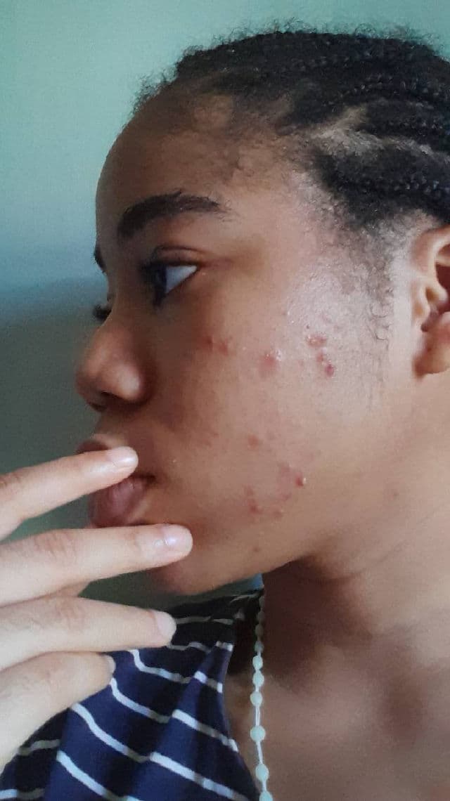 CURENTY Acne Clear Serum review photo by SkinWithNue