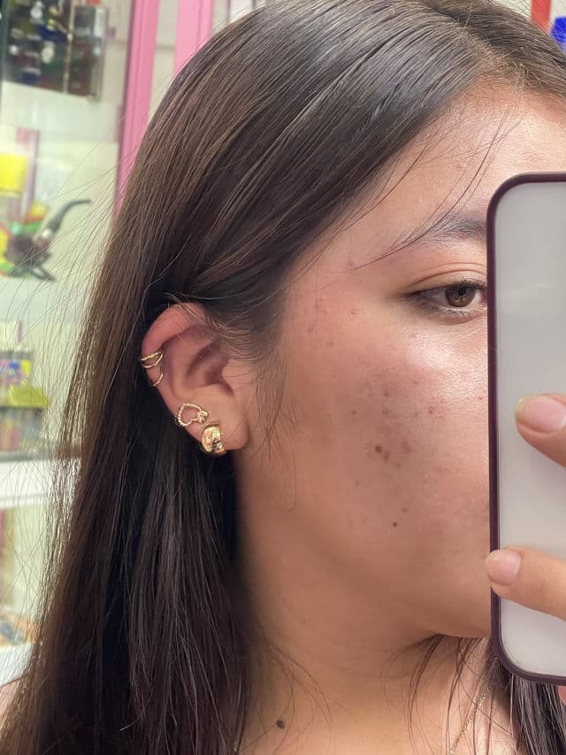 Differin Adapalene Cream 0.1% review photo by abitoscano15