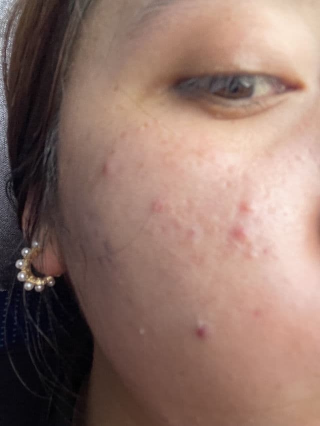 Differin Adapalene Cream 0.1% review photo by abitoscano15