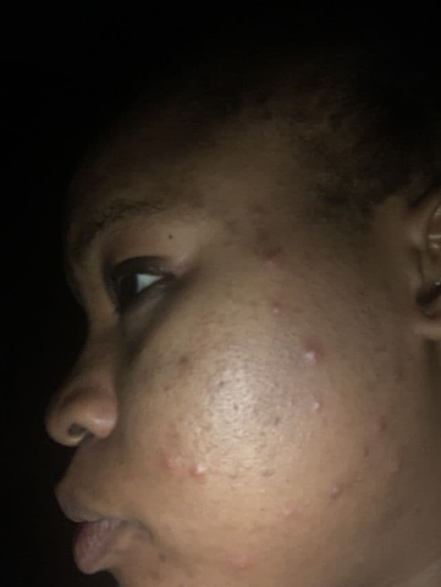 Some By Mi 30 Days Miracle Tea Tree Clear Spot Oil review photo by shiroro