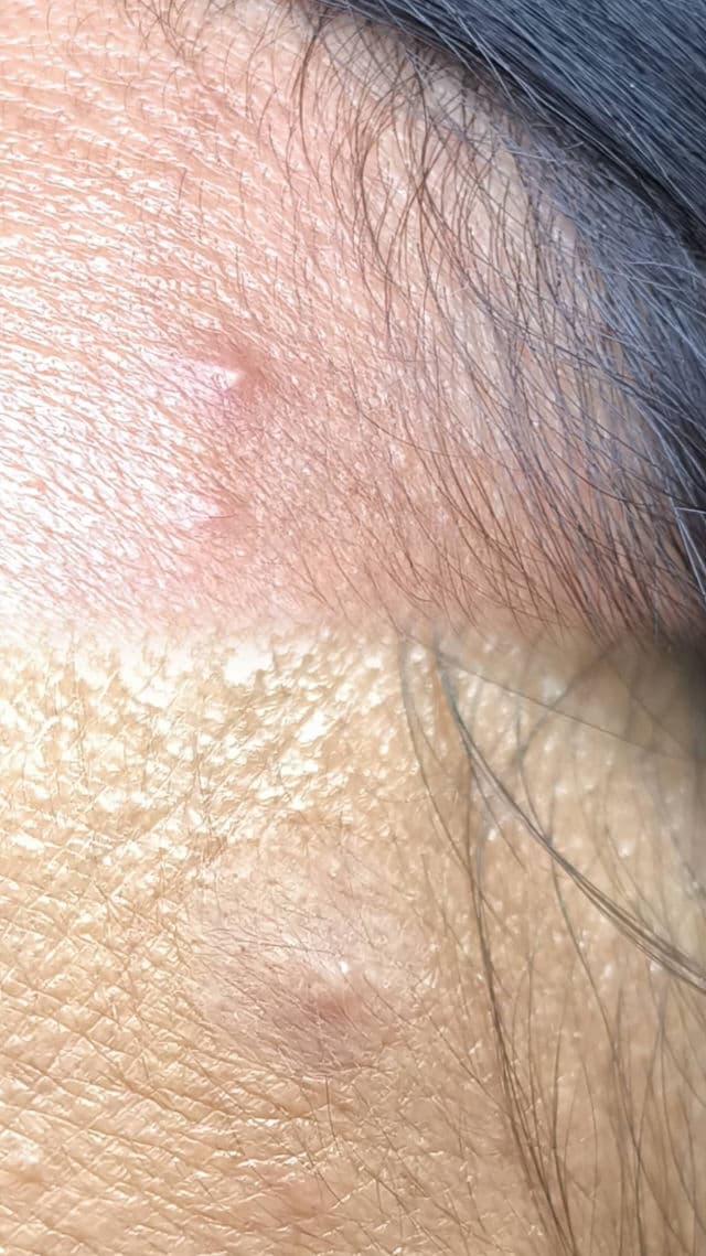 ISNTREE Onion Newpair Spot Patch - Basic review photo by letsdewit