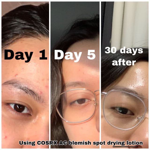 COSRX AC Collection Blemish Spot Drying Lotion review photo by Acdv
