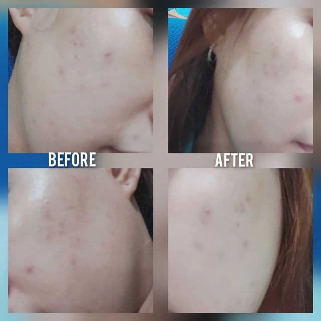 Garnier Bright Complete 3-in-1 Anti Acne Facial Wash review photo by Trace