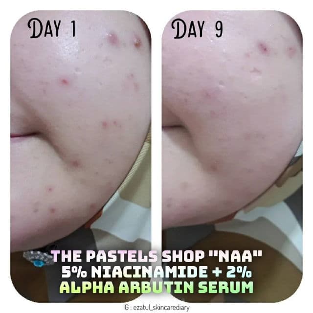 The Pastels Shop "NAA" 5% Niacinamide + 2% Alpha Arbutin Serum review photo by ezatulSkincareDiary