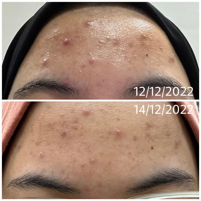 Mizon Good Bye Blemish Soothing Gel Cream review photo by izzaatiaqilah