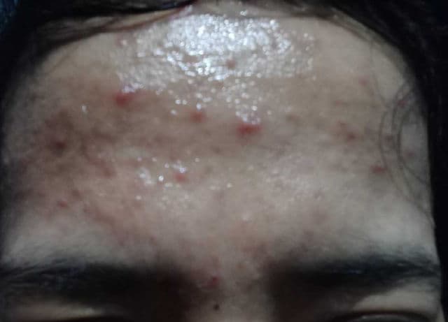 Innertrue Acneficent Treatment Gel review photo by Delima____12 