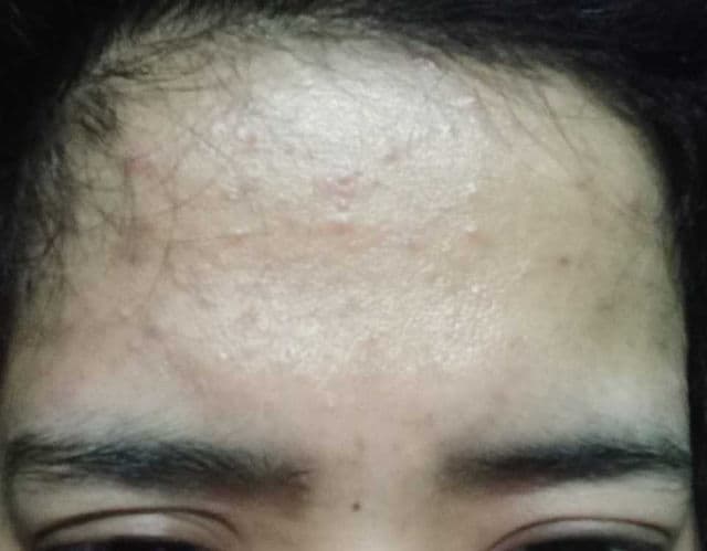 Innertrue Acneficent Treatment Gel review photo by Delima____12 