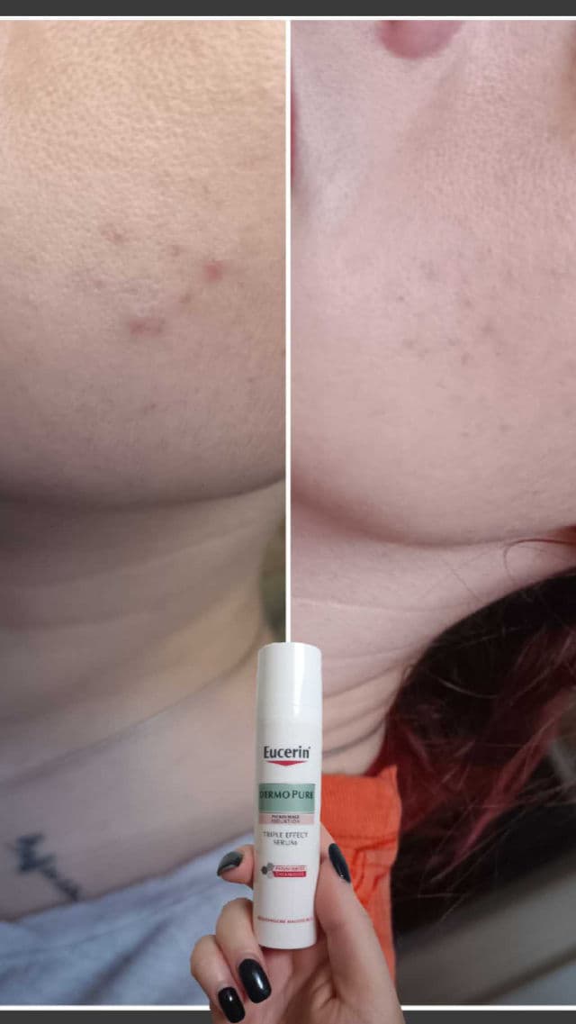 Eucerin DermoPurifyer Triple Effect Serum review photo by mycupoftea