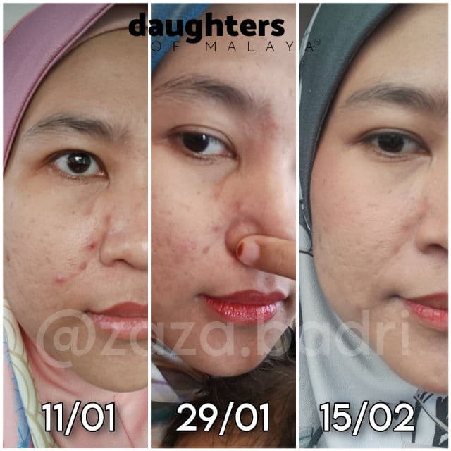 Daughters of Malaya Post-Breakout Recovery Serum  review photo by zazabadri