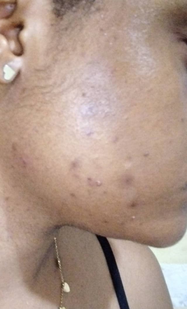 Azelaic Acid 10 Hyaluron Redness Soothing Serum product review