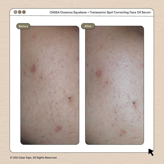 OASEA Oceanus Squalane + Tranexamic Spot Correcting Face Oil Serum review photo by dearsqin
