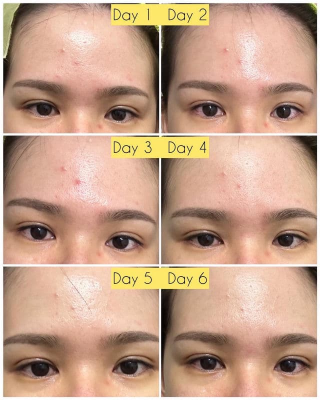 Bffect Totara Acid-Free Anti-Acne Essence review photo by bubblyvivi