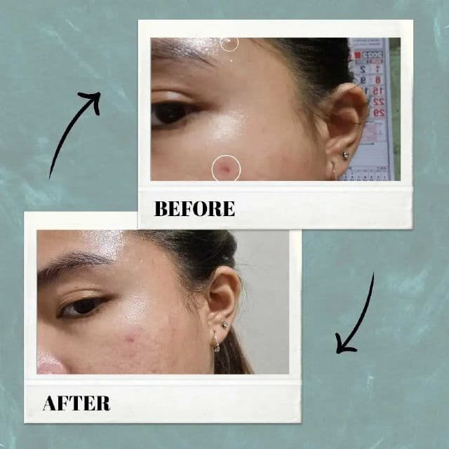 VT COSMETICS Cica Spot Patch review photo by moirascstash
