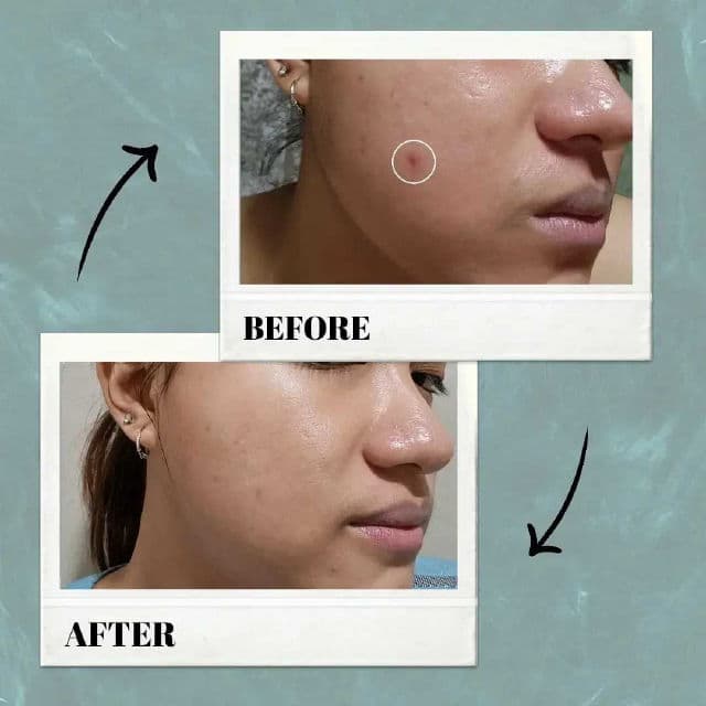 VT COSMETICS Cica Spot Patch review photo by moirascstash
