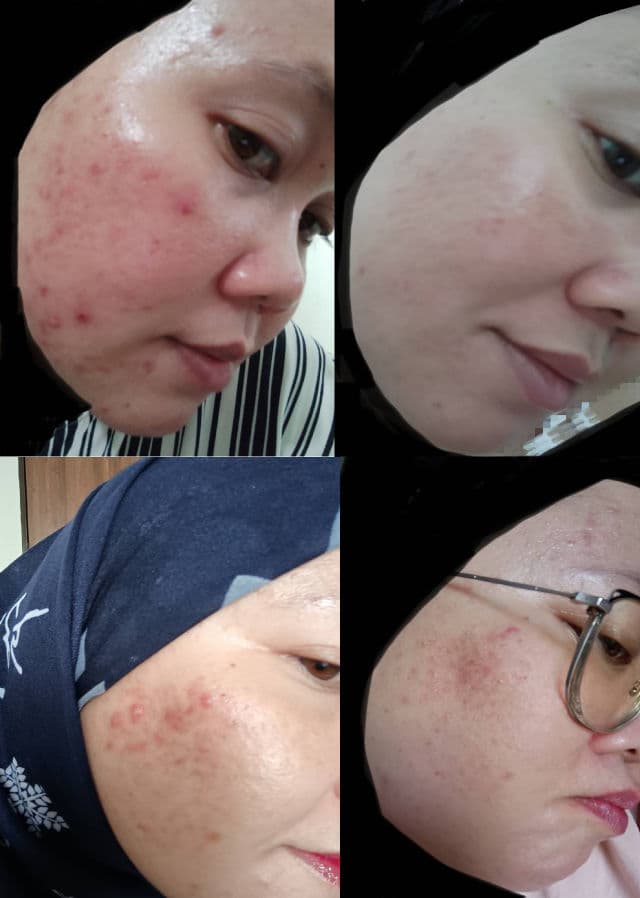 Kinfairy Niacinamide 5% + Alpha Arbutin 2% Anti-Scar Glow Serum review photo by Jamalia