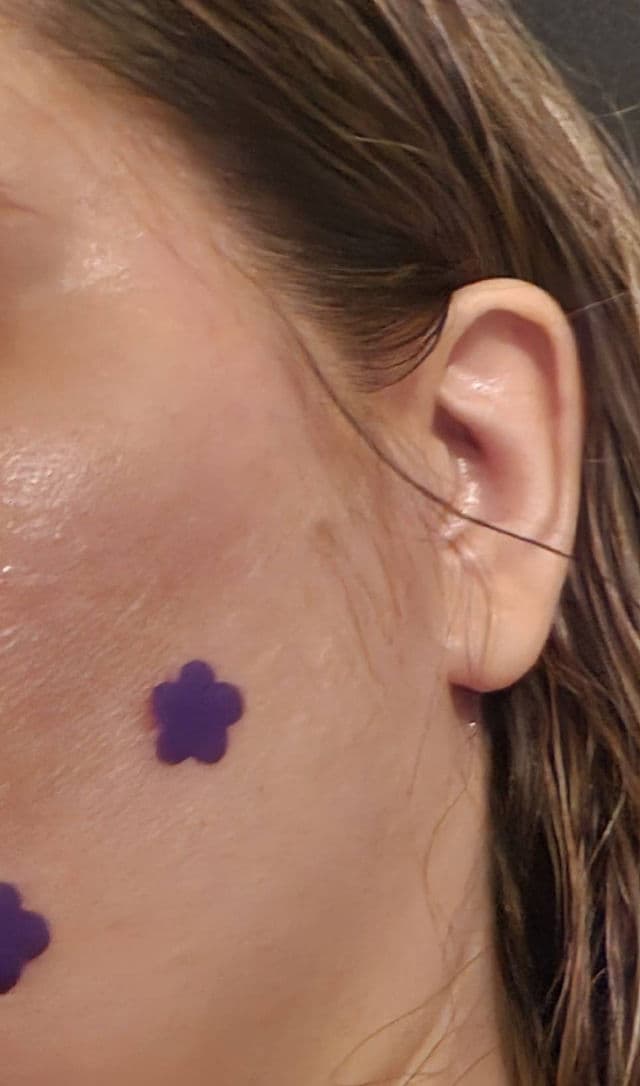 Blume Blume Buds Power Patches for Acne review photo by divabud