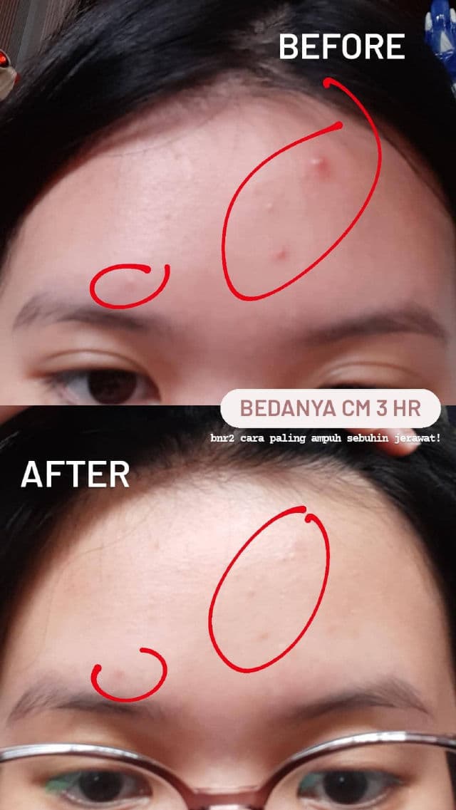 Avoskin Your Skin Bae Salicylic Acid 2% + Zinc review photo by Acnebutbetter