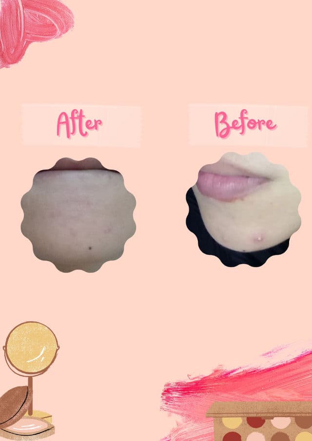 KLOIS Blemish Skin Serum review photo by Ailau