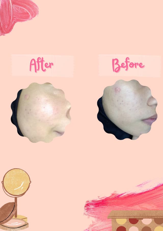 KLOIS Blemish Skin Serum review photo by Ailau