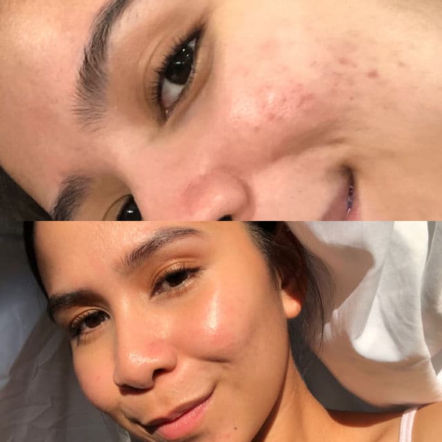 The Ordinary Niacinamide 10% + Zinc 1% review photo by Aixx