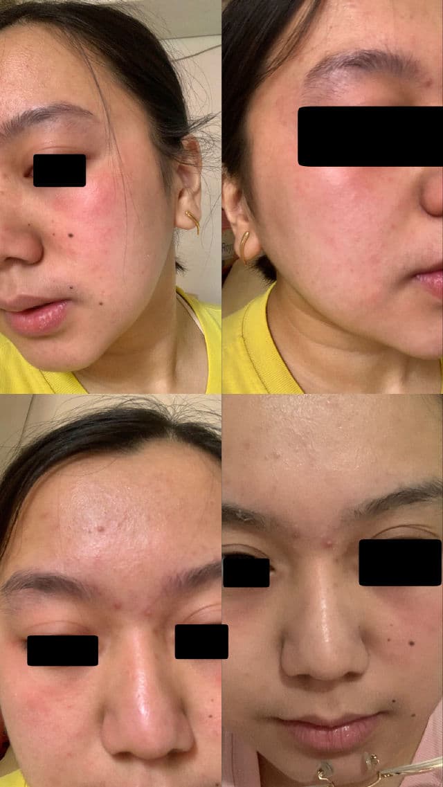 COSRX One Step Pimple Clear Pads review photo by Acdv