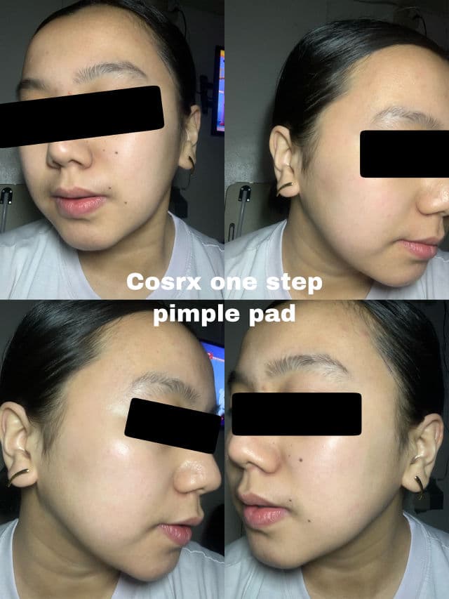 COSRX One Step Pimple Clear Pads review photo by Acdv