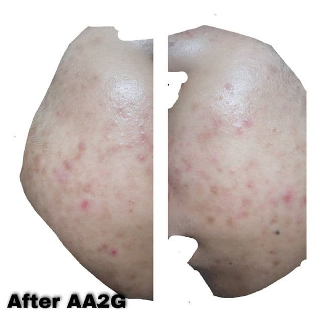 The Pastels Shop AA2G Hyperpigmentation Treatment Serum review photo by Arraaida