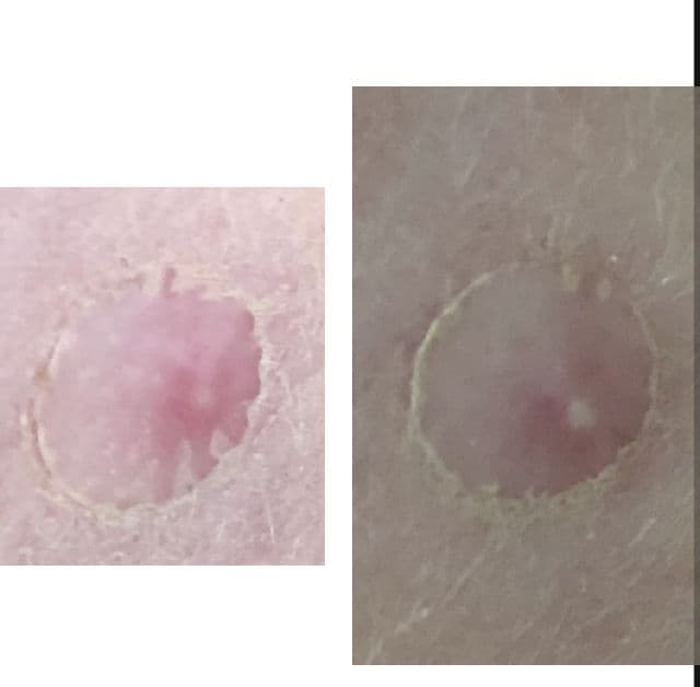 Lanbena Acne Pimple Patch for Daytime review photo by CherylB