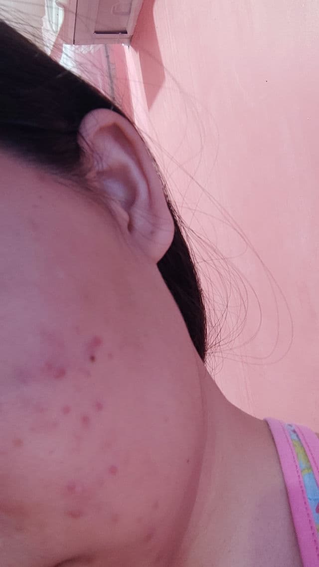 Galderma Benzac AC 2.5% review photo by ClaudinePonce