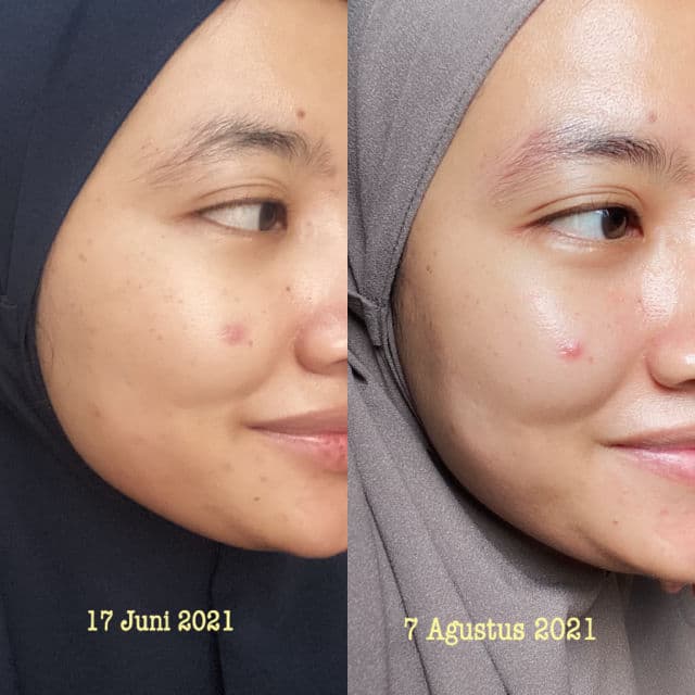 The Aesthetics Skin Dinar Amanda Skin Reboot Daily Exfoliating Gel review photo by Glienmourinsie