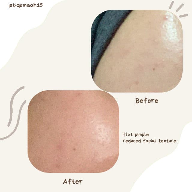 Acnol Gel for Acne review photo by Istiqomah