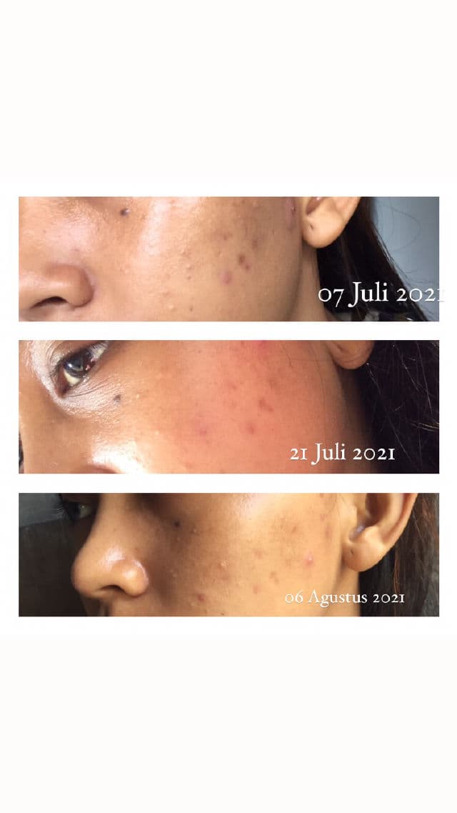 Avoskin Your Skin Bae Niacinamide 12% + Centella Asiatica review photo by Kalpika