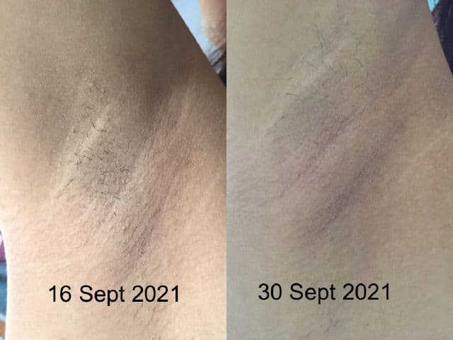 Roceo Lightening & Smoothing Underarm & Skin Fold Serum review photo by Kalpika