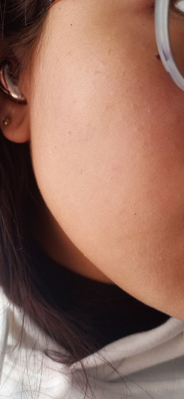 Acnemy Postzit® Correcting Serum review photo by LilyMoon