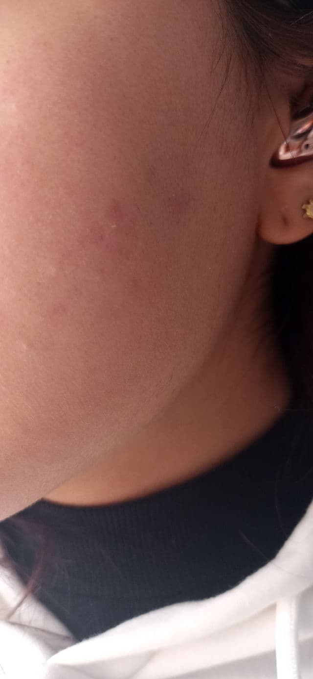 Acnemy Postzit® Correcting Serum review photo by LilyMoon