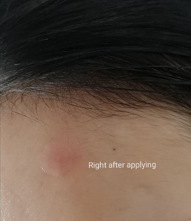 ETUDE AC Clean Up Spot Patch review photo by Masktery