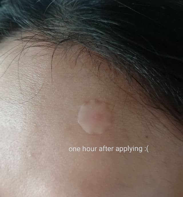 ETUDE AC Clean Up Spot Patch review photo by Masktery