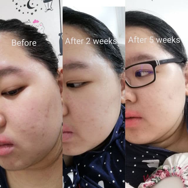 Garnier Skin Naturals - Pure Active Multi-Action Toner review photo by Muziz