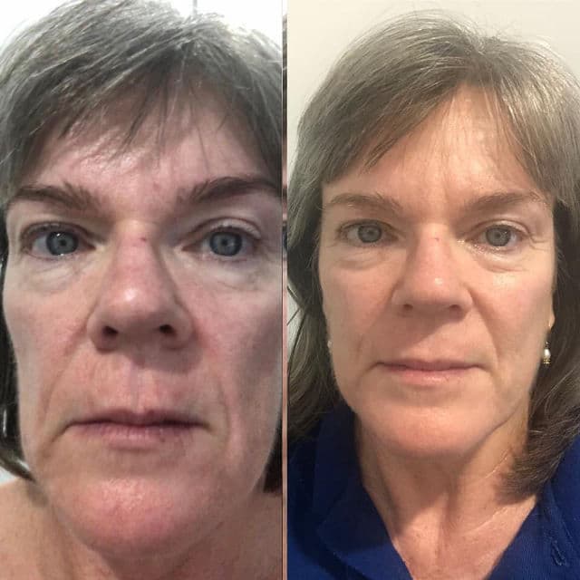 Stiefel Stieva-A 0.025% Tretinoin Cream USP review photo by NarsBars