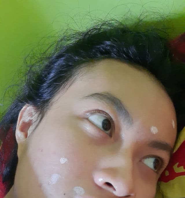 Skin game Acne Warrior review photo by Nrmlapw