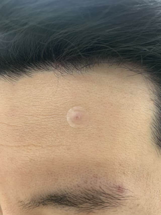 NolaHour Hydrocolloid Clear Soothing Pimple Patch for Acne Recovery Stage review photo by Picky73069