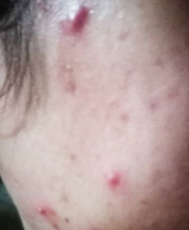 Oxecure Acne Clear Powder Mud review photo by PickyAddict